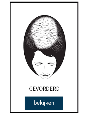gevorderd haaruitval gevorderd haaruitval